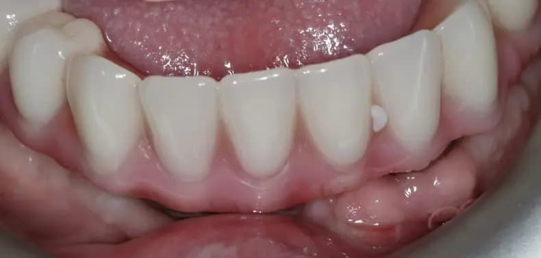 After Full arch dental implants