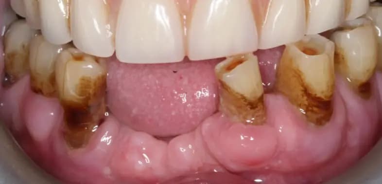 Before Full arch dental implants