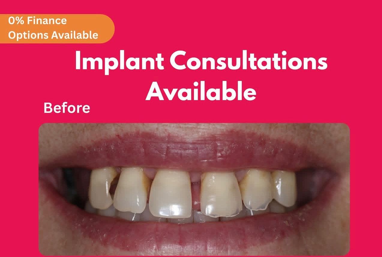 Complete dental transformation with full-arch implants