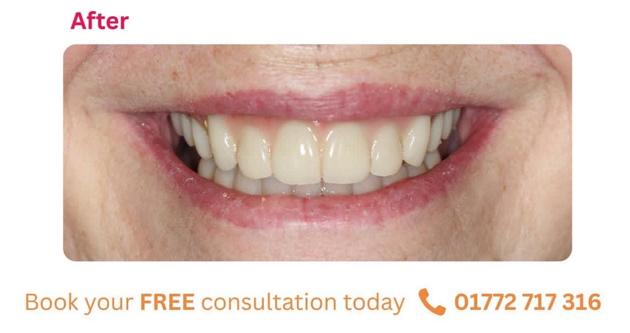 Complete dental transformation with full-arch implants