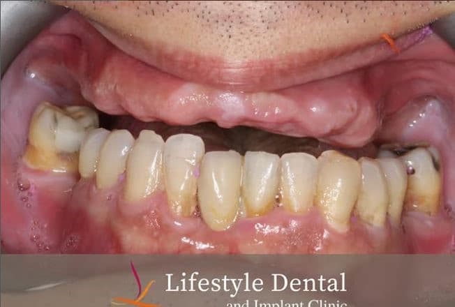 Both arches full-arch dental implants result