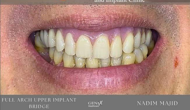 Full smile restoration with dental implants